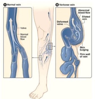 What is the Best way to Prevent Varicose Veins? – Lasso® UK by HOL